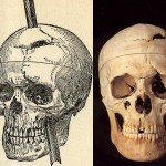 Phineas Gage